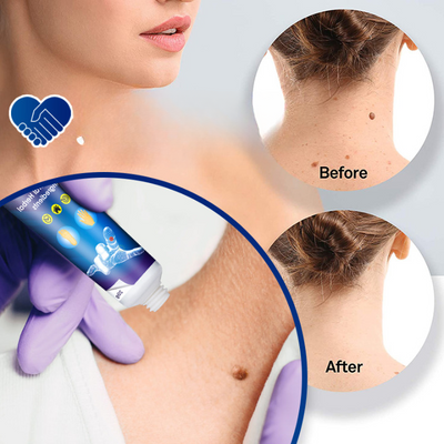 Wabra™ - Crema per verruche profondamente efficace