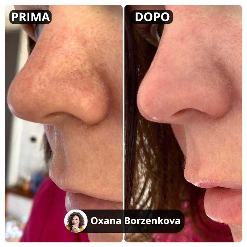 Kit per il trattamento dei punti neri 2.0