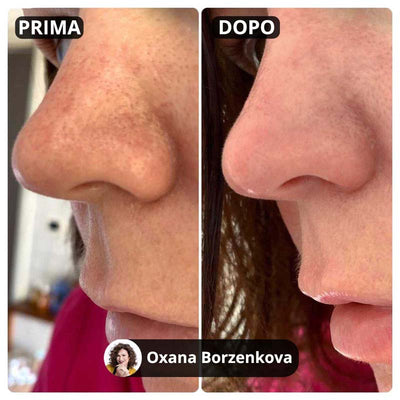 Kit per il trattamento dei punti neri 2.0